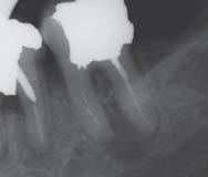 При лечении зуба сломалась игла