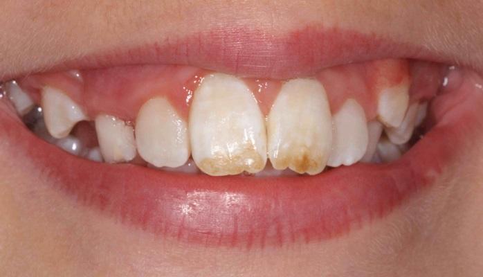 Признаки флюороза зубов становятся менее видимыми по мере взросления