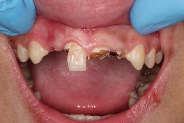 Восстановление передних зубов у 12 летнего ребенка