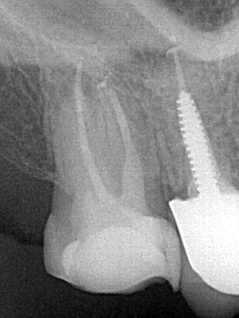 корневые каналы 1.7 зуба 3D-обтурированы, в небном канале зафиксирован стекловолоконный штифт