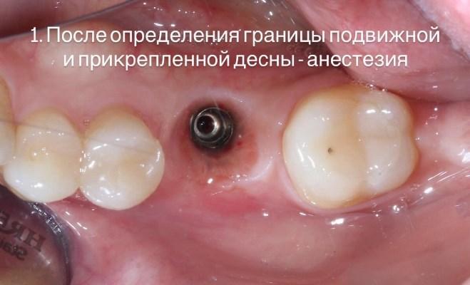 Создание прикрепленной кератинизированной десны в области имплантатов - необходимость или опция?
