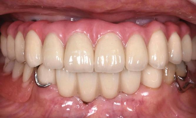 Реабилитация на имплантатах полной зубной дуги верхней челюсти с использованием цифрового рабочего процесса (двухлетнее наблюдение)