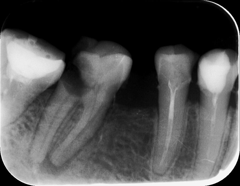 Удаление зуба семерки. Внутриротовая прицельная рентгенограмма. Радиовизиография (прицельный снимок зуба). Периодонтит радиовизиография. Рентген пульпита зуба 4.7.