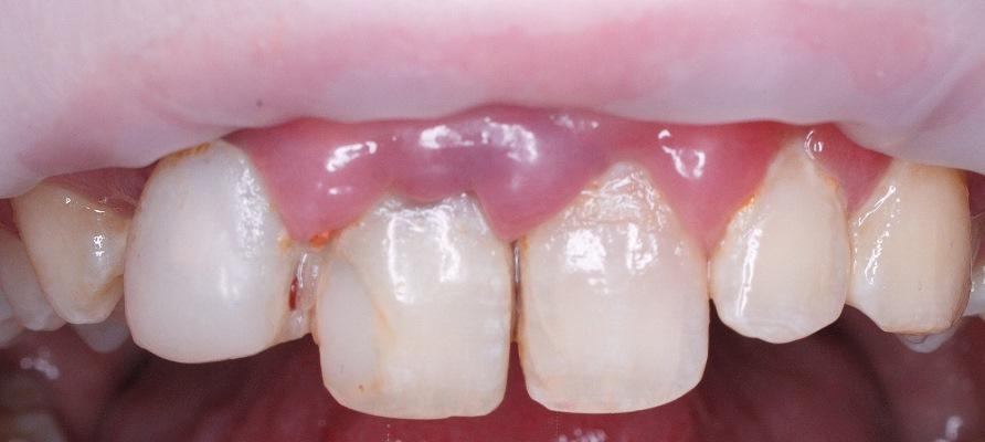 Одномоментная имплантация в области зуба 1.1