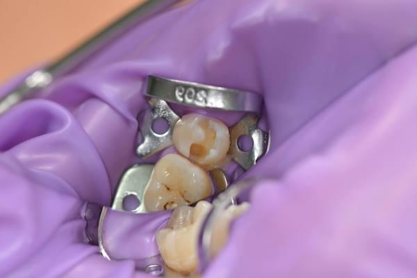 Лечение кариеса и прямая реставрация зубов 1.4, 1.5