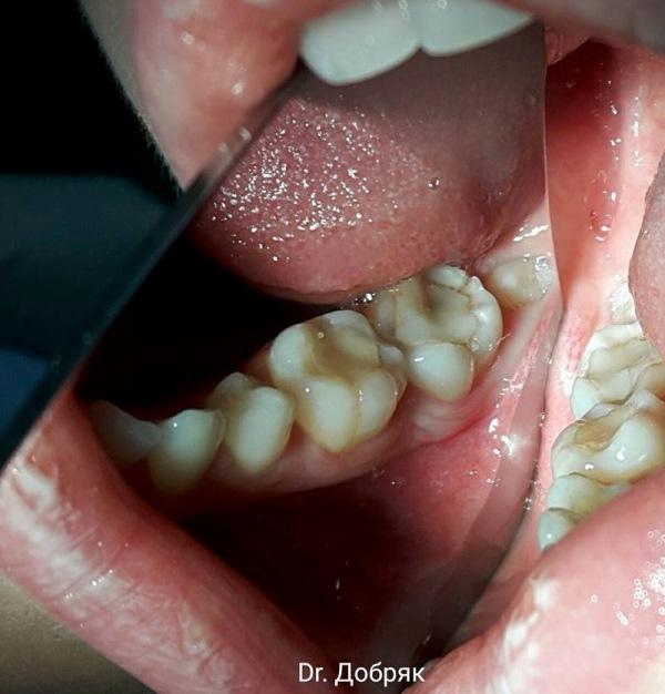 Реплантация 48 зуба в лунку удалённого 47 (вариант решения замещения дефекта после удаления)