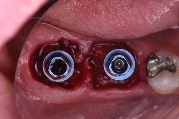 Немедленная имплантация в лунки двух зубов