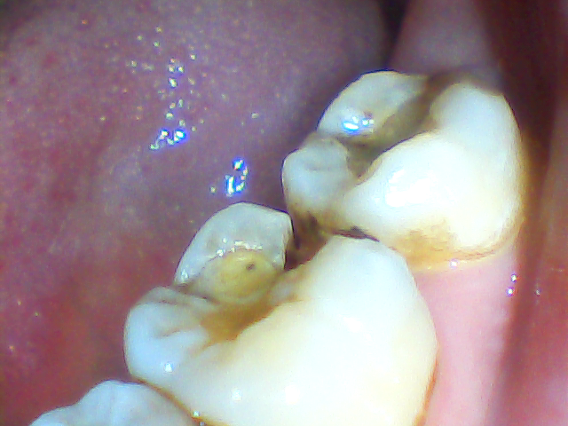 Еда застряла между зубов — недорогая стоматология на Каширском шоссе в Москве