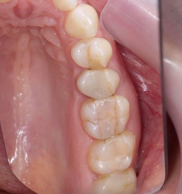 Функциональное и эстетическое восстановление жевательных зубов