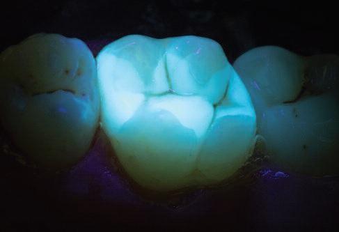 Люминесцентный метод в стоматологии