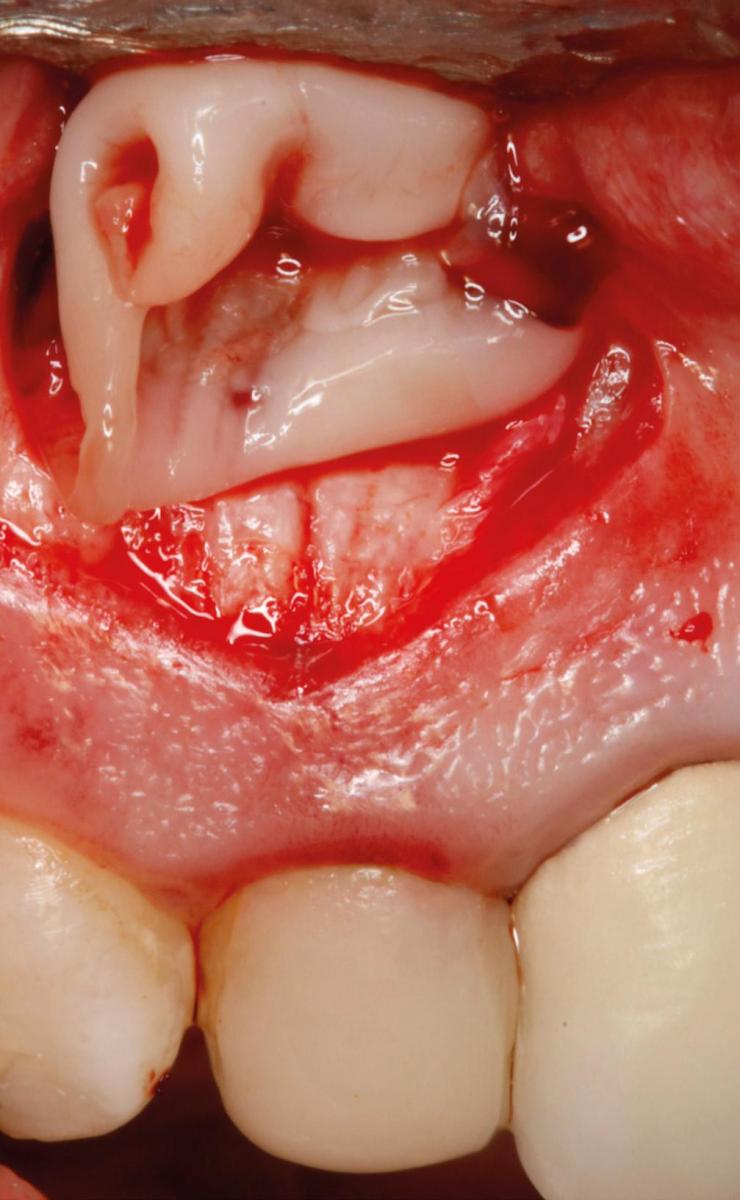 Периапикальное хирургическое лечение зубов