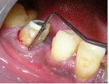 Вертикальный перелом корня зуба