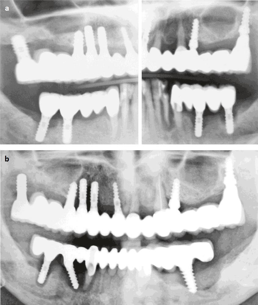 Восстановление костной ткани зубов. Деструкция костной ткани челюсти. Костная резорбция челюсти. Остеопластика верхней челюсти. Остеопластика костной ткани челюстей.
