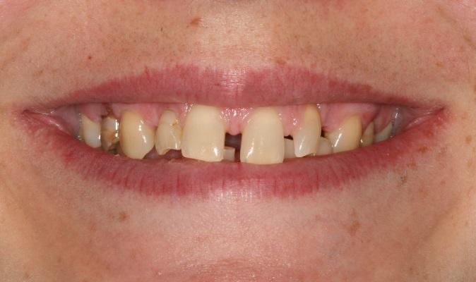 Комплексная реабилитация пациента с врожденной адентией постоянных зубов