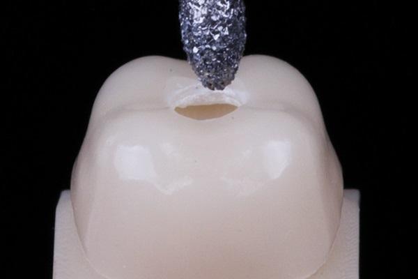 Предотвращение перелома керамических конструкций во время эндодонтического лечения