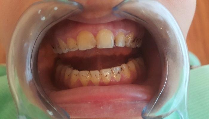 Каким образом зубной налет защищает грибковые инфекции от действия противогрибковых препаратов у детей