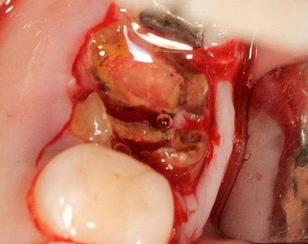 Экстракция и немедленная имплантация в область 46 зуба