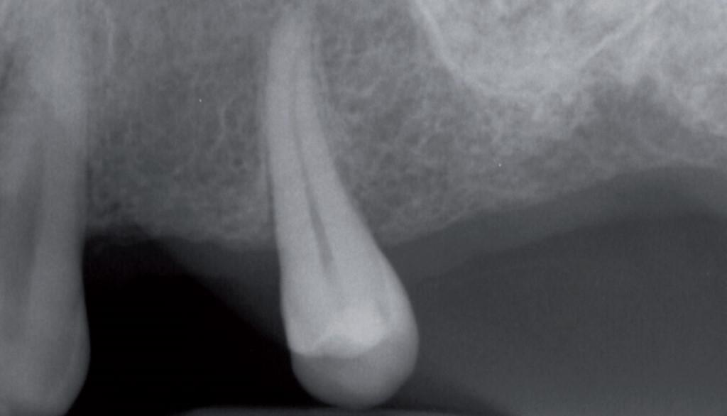 Подкожная эмфизема при лечении зуба