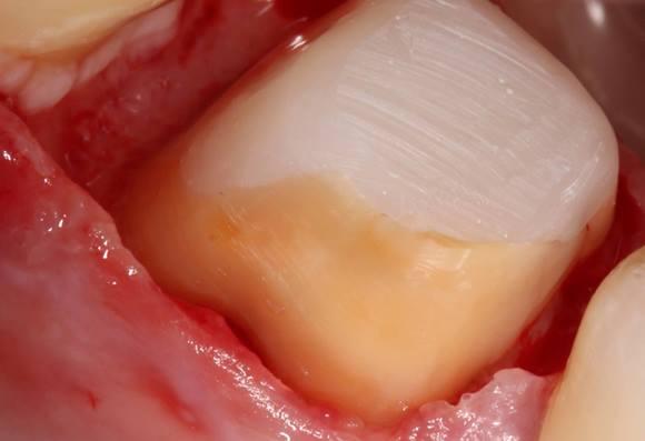 Хирургическое удлинение зуба 4.6 с последующим протезированием металлокерамической коронкой