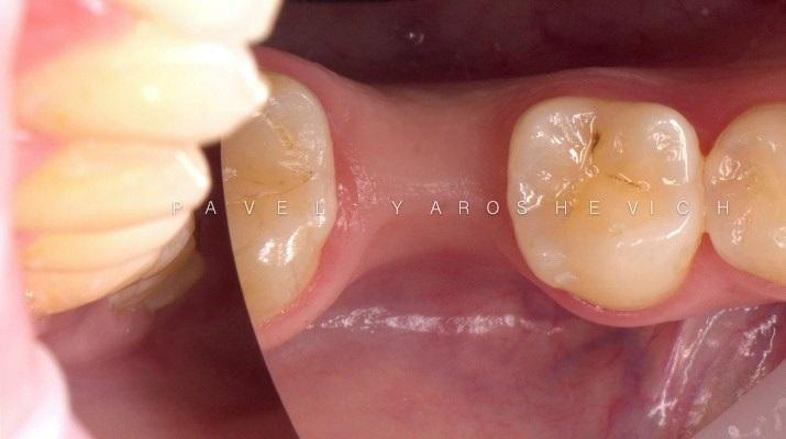 Мягкотканная аугментация в области 35 зуба