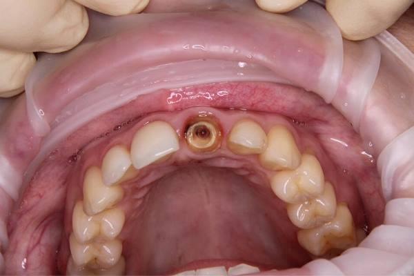Сохранение зуба путём экструзии - лучшая альтернатива имплантации