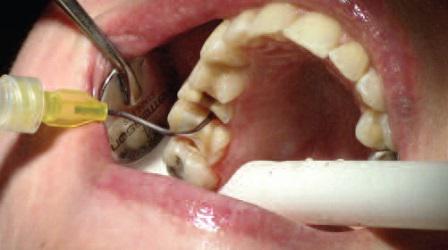Минимально-инвазивный подход с учетом биомеханики зубов