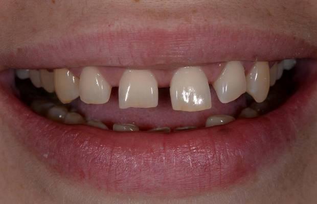 Тотальная реконструкция зубов верхней и нижней челюсти