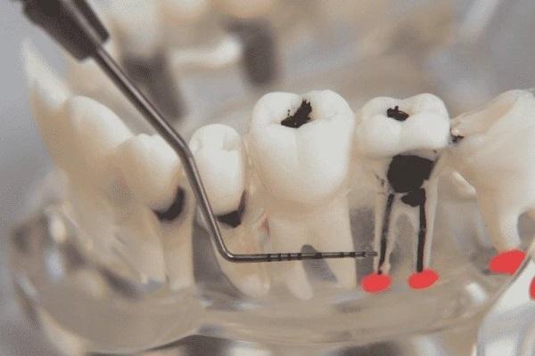 Возможно, диаминфторид серебра станет решением проблемы снижения чувствительности зубов