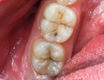 Водно абразивное лечение зубов