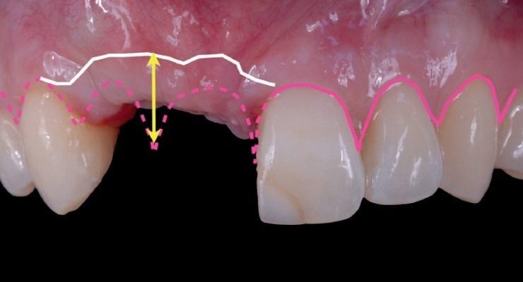 Гибридные реставрации во фронтальном участке: замещение дефектов зубного ряда
