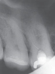 Перелом инструмента в канале зуба