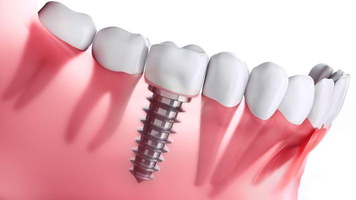 В Германии разработали противовоспалительное покрытие для зубных имплантатов