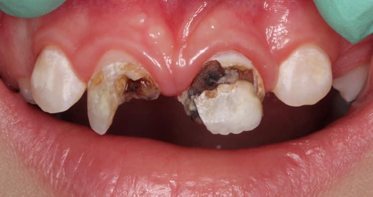 Реставрация 11, 21 зуба с точечным вскрытием пульпы в процессе лечения