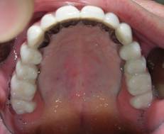 зубной протез с опорой на импланты
