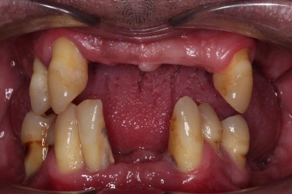 Стоматологическая реабилитация после потери всех зубов по причине пародонтита (олонфо - зубы в день операции)