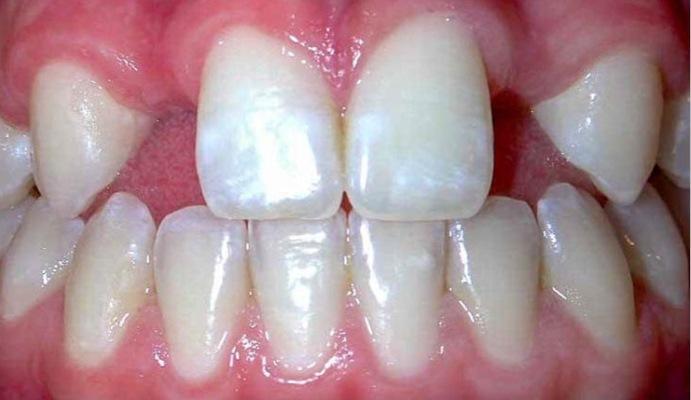 Исследователи изучают связь между агенезией зубов и атопическим дерматитом