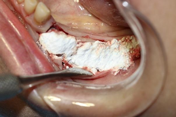 Увеличение ширины альвеолярного гребня в боковых отделах для установки имплантата с использованием техники применения костного цемента на основе сульфата кальция