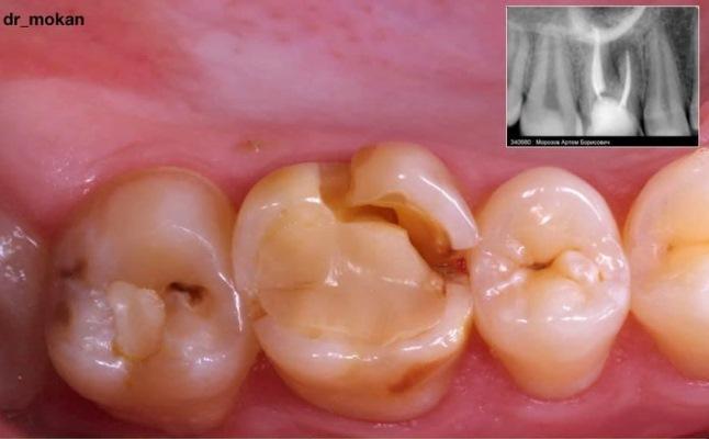 Трансплантация зуба 1.8 в зону удаляемого зуба 1.6