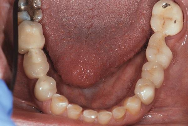 Интрузия зубов при ортодонтическом лечении