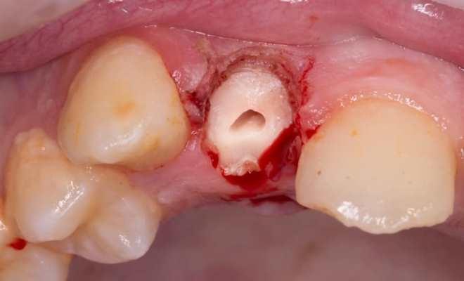 Спасение зуба 1.2 после травмы