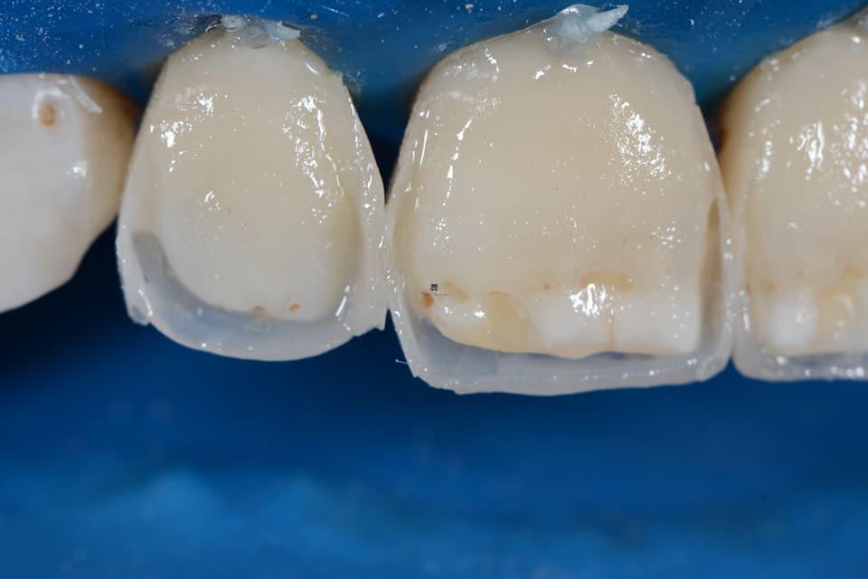 Зубная реставрация