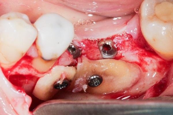 Трансплантация корней - использование корней зубов при лечении недостаточности костной ткани