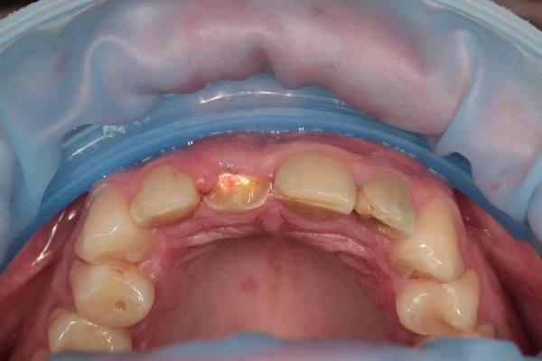 Частичное удаление зуба по методике Socket-Shield
