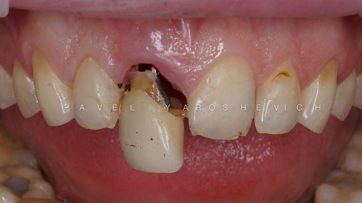 Удаление 11 зуба и одномоментная имплантация