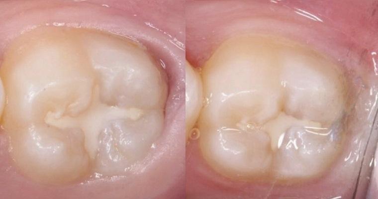 Передэруптивные патологии зубов: результат 9 лет мониторинга