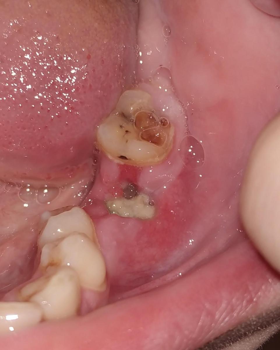 Гной в лунке после удаления зуба