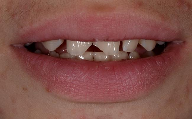 Травматический скол зубов 1.1, 2.1 у ребенка 13 лет