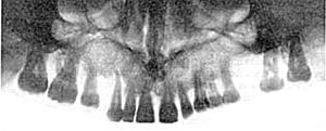 Панорамная рентгенограмма верхней челюсти