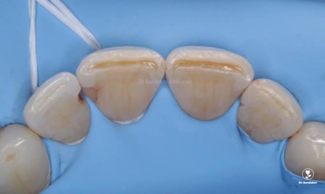 Подготовка к ортодонтии - лечение кариеса зубов 1.1, 1.2