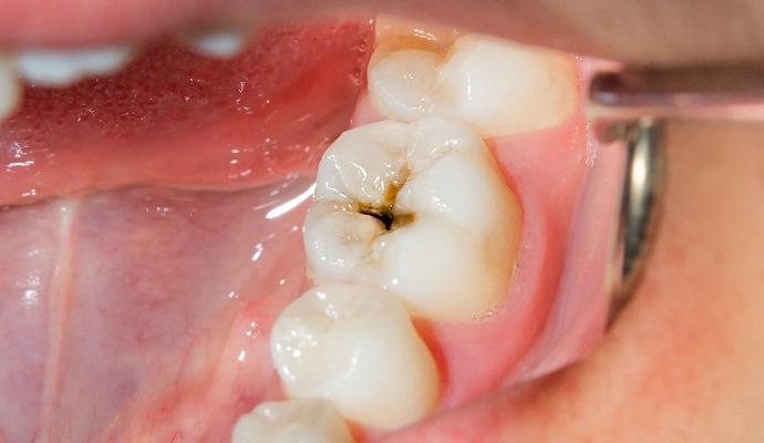 Селеновые зубные герметики могут помочь в профилактике кариеса